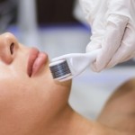 Derma Roller
