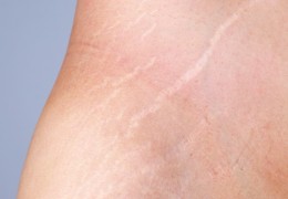 Tatuaggio medicale smagliature: protocolli operativi e resa cromatica